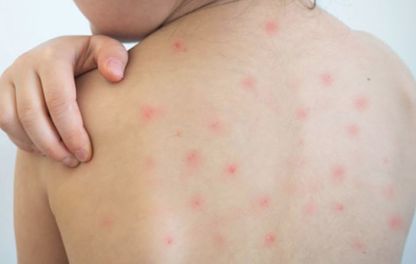 Ministerio de Salud coordinará con el Sedes de Santa Cruz para evitar la propagación del sarampión