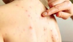 Brotes de sarampión, influenza y chikungunya colapsan hospitales en Santa Cruz, según Fesirmes
