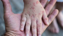 En Tarija confirman 5 contagios de sarampión y 45 casos sospechosos