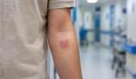 Crean un “vendaje vivo” que promete curar heridas en tiempo récord