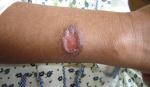 Santa Cruz registra 210 casos de leishmaniasis y refuerza la vigilancia sanitaria