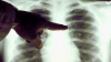 Un-nuevo-tratamiento-en-Espana-logra-erradicar-el-cancer-de-pulmon-en-casi-un-37%-de-los-casos